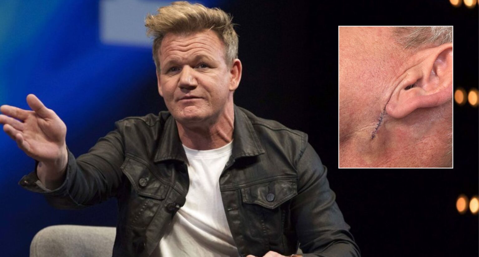 Gordon Ramsay Undergoes Surgery After Skin Cancer Diagnosis